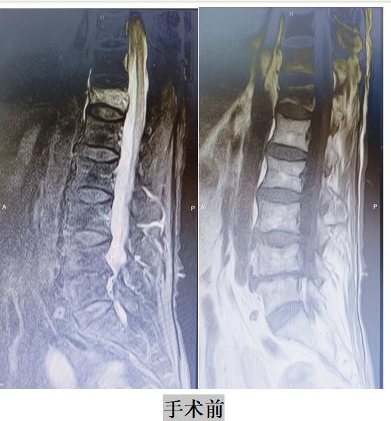 91岁杨某腰部疼痛致不能行走,年迈老人还能康复吗?