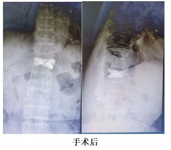 91岁杨某腰部疼痛致不能行走,年迈老人还能康复吗?