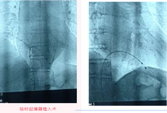【再突破】松桃县民族中医院成功开展首例临时起搏器植入术