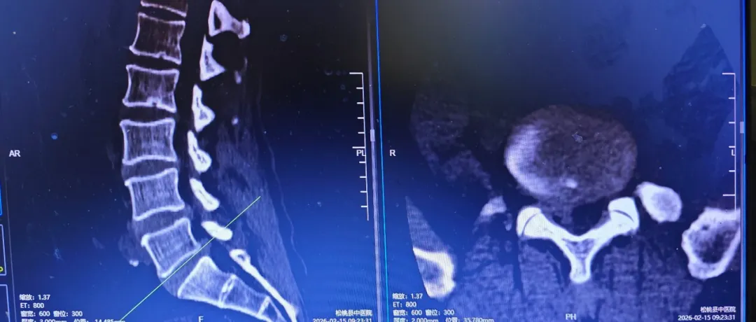 得了椎间盘突出症后，他做出选择~~~