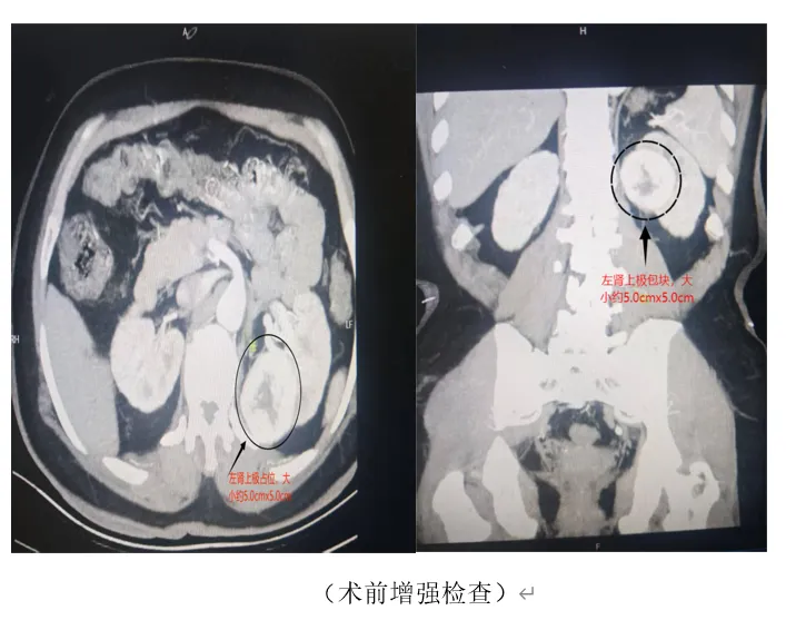 小结石引起的疼痛，竟然挽救他的命