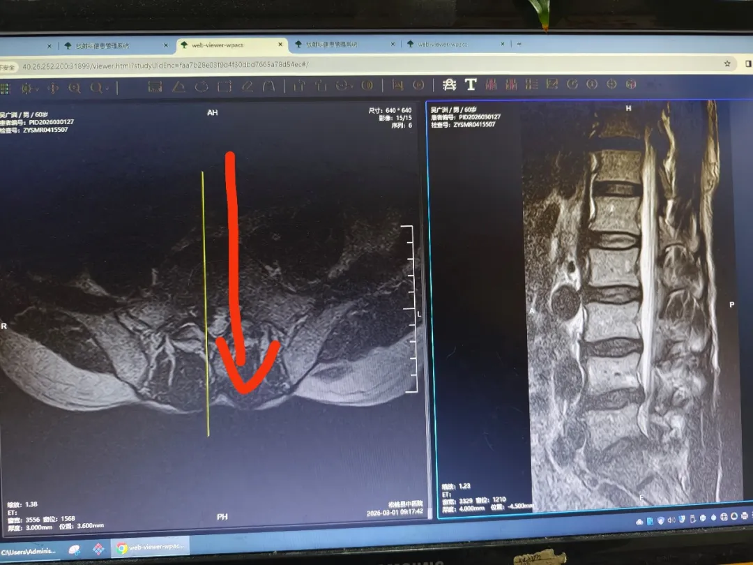 松桃县民族中医院骨二科：微创除顽疾  苗药助康复